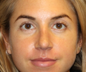 Rhinoplasty Before & After Patient #29808