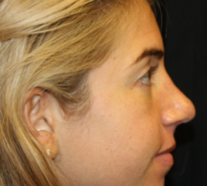 Rhinoplasty Before & After Patient #29808