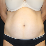 Tummy Tuck Before & After Patient #30079