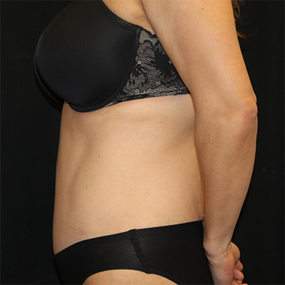 Tummy Tuck Before & After Patient #30079