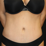 Tummy Tuck Before & After Patient #30079