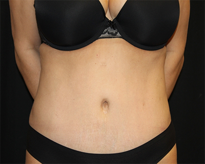 Tummy Tuck Before & After Patient #30079