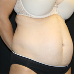 Tummy Tuck Before & After Patient #30079