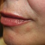 Lip Filler Before & After Patient #29927