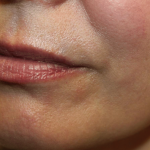 Lip Filler Before & After Patient #29927