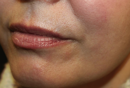 Lip Filler Before & After Patient #29927