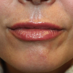 Lip Filler Before & After Patient #29927