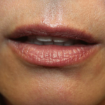 Lip Filler Before & After Patient #29927