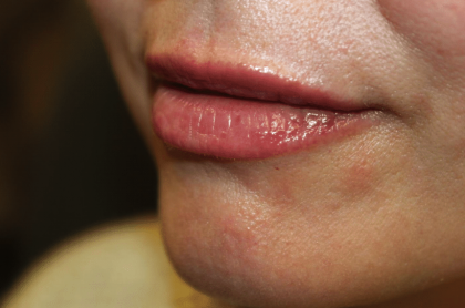 Lip Filler Before & After Patient #29927