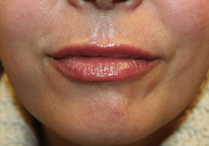 Lip Filler Before & After Patient #29927