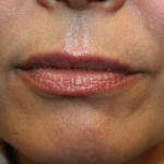 Lip Filler Before & After Patient #29927