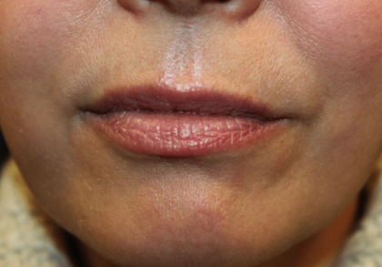 Lip Filler Before & After Patient #29927