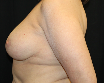 Breast Reduction Before & After Patient #30101