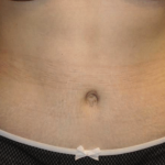 Tummy Tuck Before & After Patient #29894