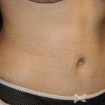 Tummy Tuck Before & After Patient #29894