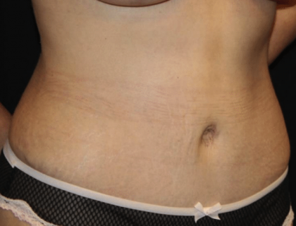 Tummy Tuck Before & After Patient #29894