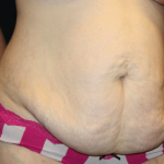 Tummy Tuck Before & After Patient #29894