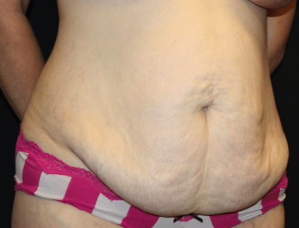 Tummy Tuck Before & After Patient #29894