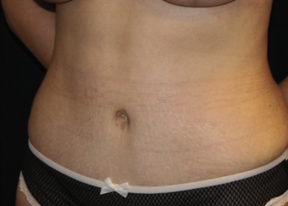 Tummy Tuck Before & After Patient #29894