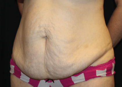 Tummy Tuck Before & After Patient #29894