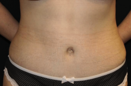 Tummy Tuck Before & After Patient #29894