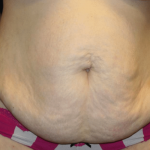 Tummy Tuck Before & After Patient #29894