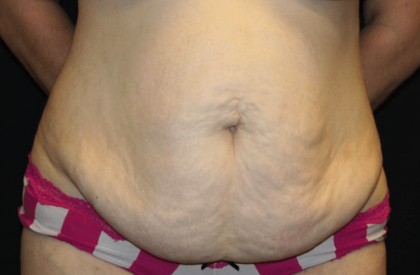 Tummy Tuck Before & After Patient #29894