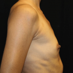 Breast Augmentation Before & After Patient #30151