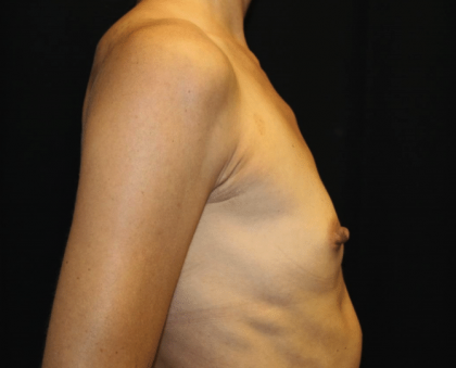 Breast Augmentation Before & After Patient #30151