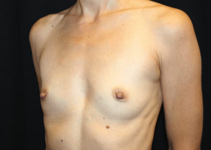 Breast Augmentation Before & After Patient #30151