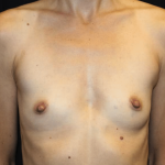 Breast Augmentation Before & After Patient #30151