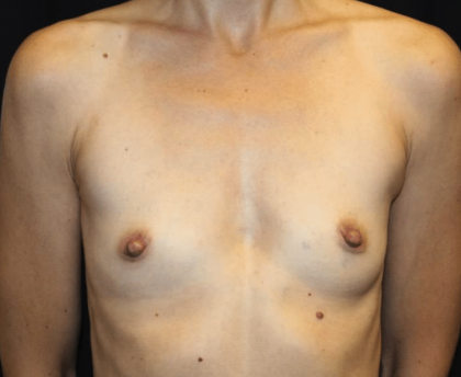 Breast Augmentation Before & After Patient #30151