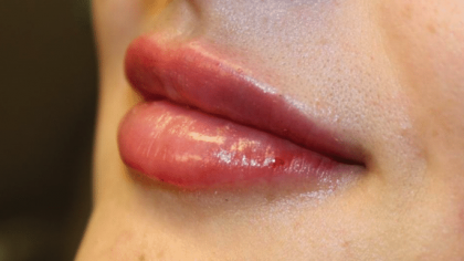 Lip Filler Before & After Patient #29960