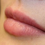 Lip Filler Before & After Patient #29960