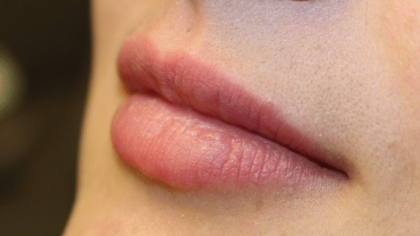 Lip Filler Before & After Patient #29960