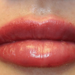 Lip Filler Before & After Patient #29960