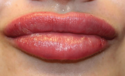 Lip Filler Before & After Patient #29960