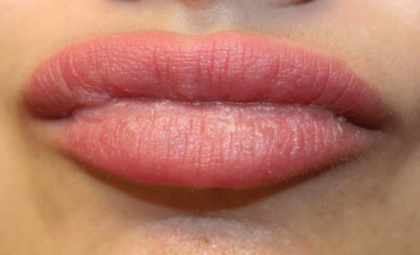 Lip Filler Before & After Patient #29960