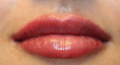 Lip Filler Before & After Patient #29960