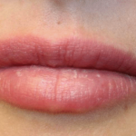 Lip Filler Before & After Patient #29960