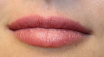 Lip Filler Before & After Patient #29960