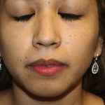 Injectable Fillers Before & After Patient #29905