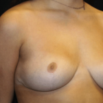 Breast Reduction Before & After Patient #29882