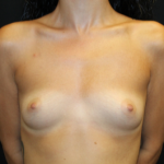 Breast Augmentation Before & After Patient #29864