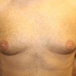 Gynecomastia Before & After Patient #29993