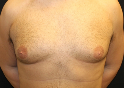 Gynecomastia Before & After Patient #29993