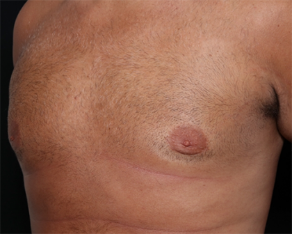 Gynecomastia Before & After Patient #29993