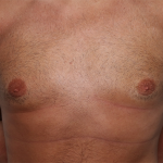 Gynecomastia Before & After Patient #29993