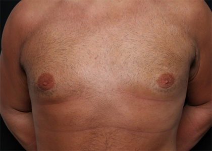 Gynecomastia Before & After Patient #29993