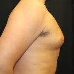 Gynecomastia Before & After Patient #29993